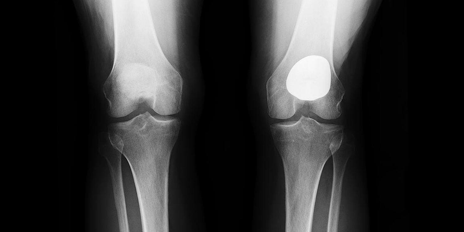 Partial Knee Replacement